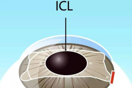 icl晶體植入后出現光圈怎么辦?